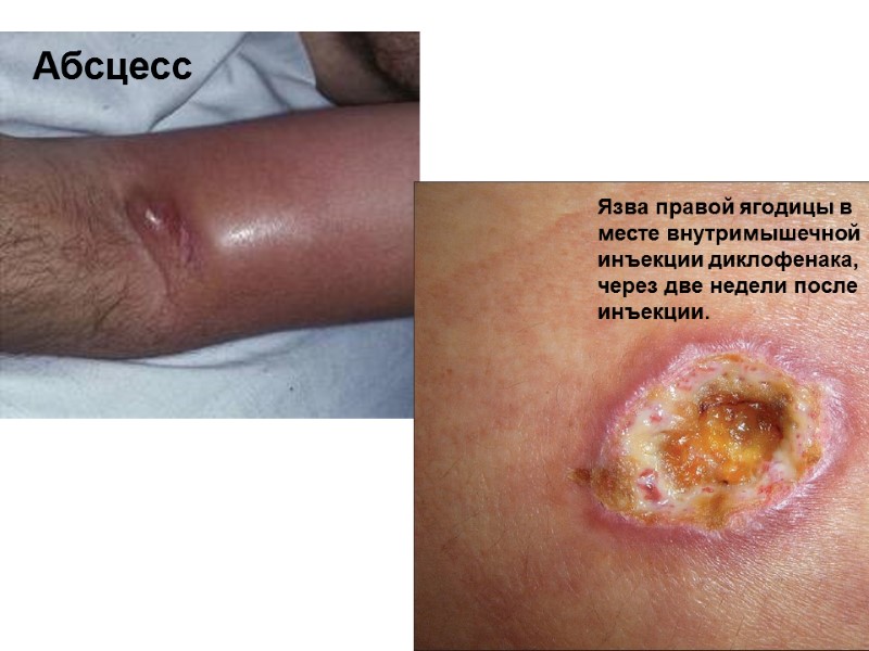 Абсцесс   Язва правой ягодицы в месте внутримышечной  инъекции диклофенака, через две